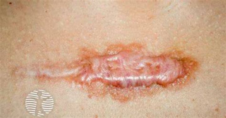 Are keloids cancerous?