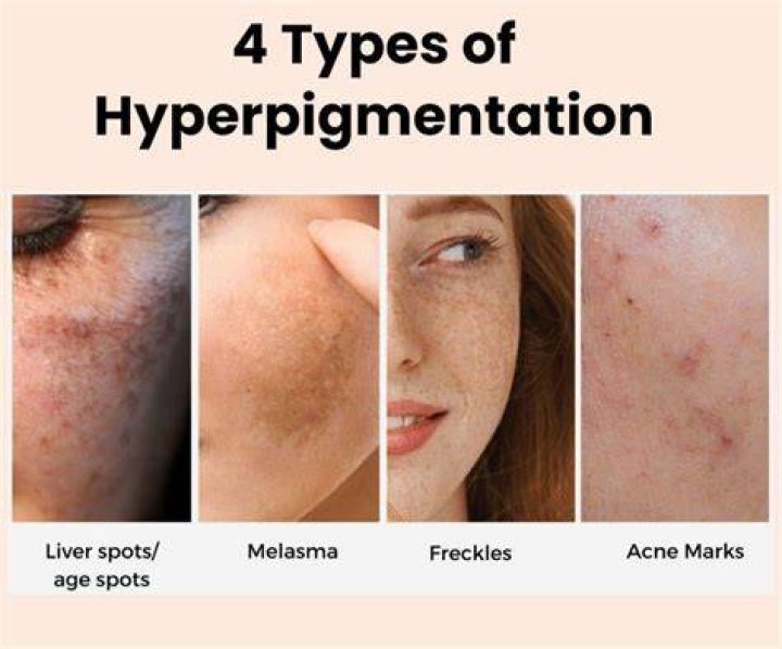 Does exfoliating make hyperpigmentation worse?