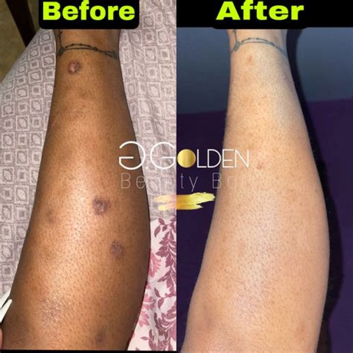 Does microneedling remove brown spots?