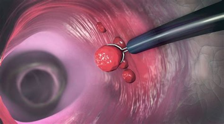How is a very large polyp removed?