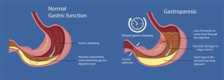 How is gastric paralysis treated?