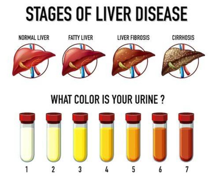 What color is urine with cirrhosis?