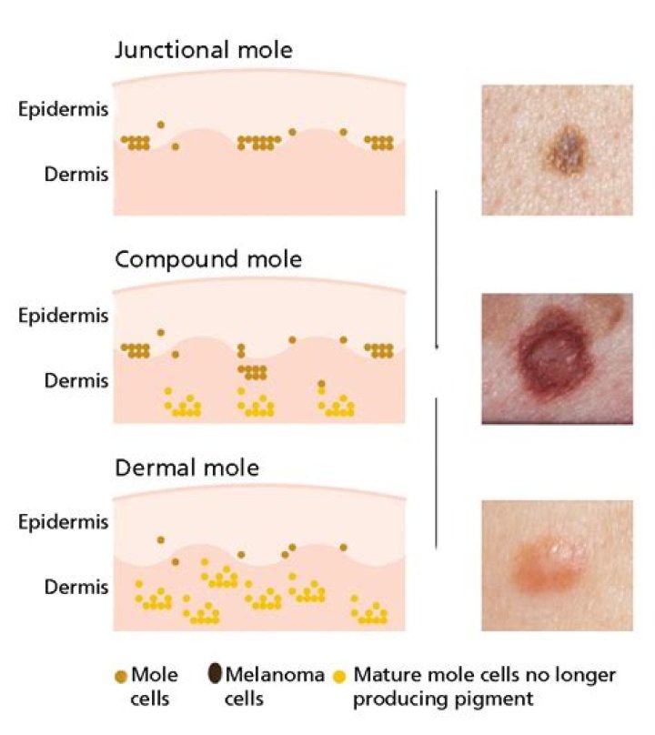 What different color moles mean?
