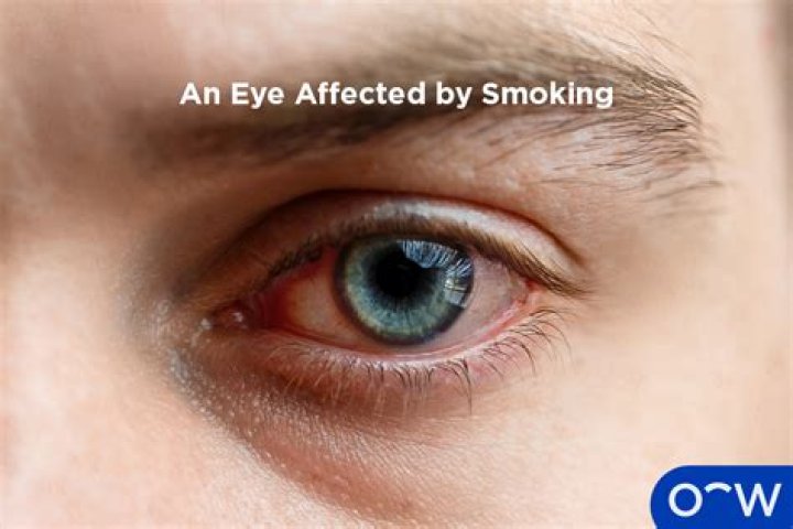 What does smoking do to your eyes?