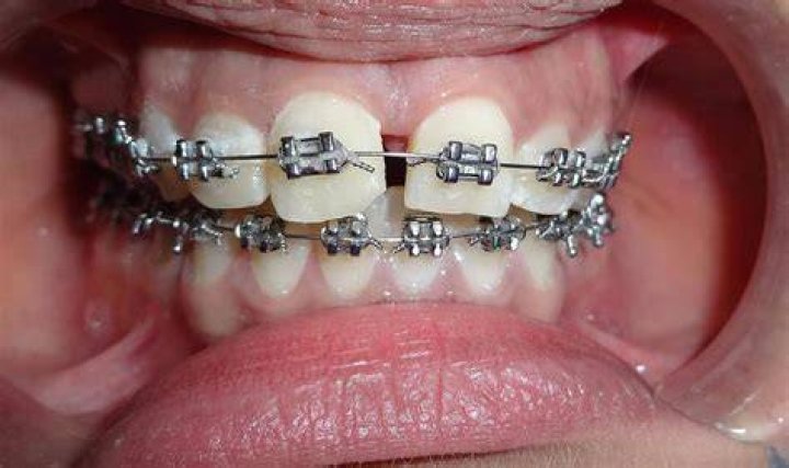 What is considered medically necessary for braces?