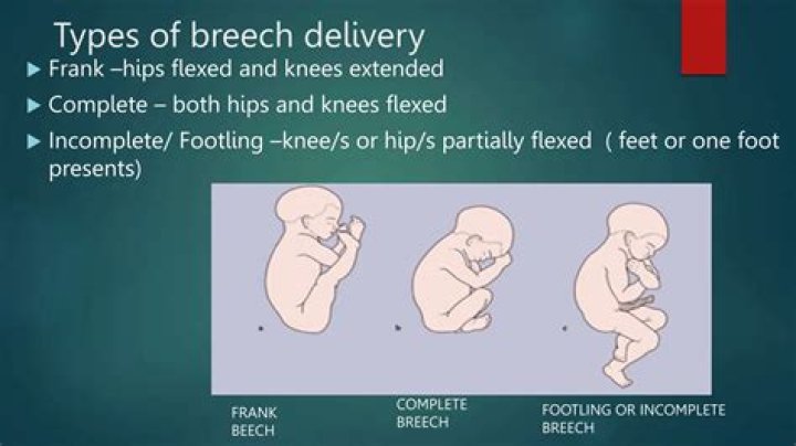 What is frank breech mean?