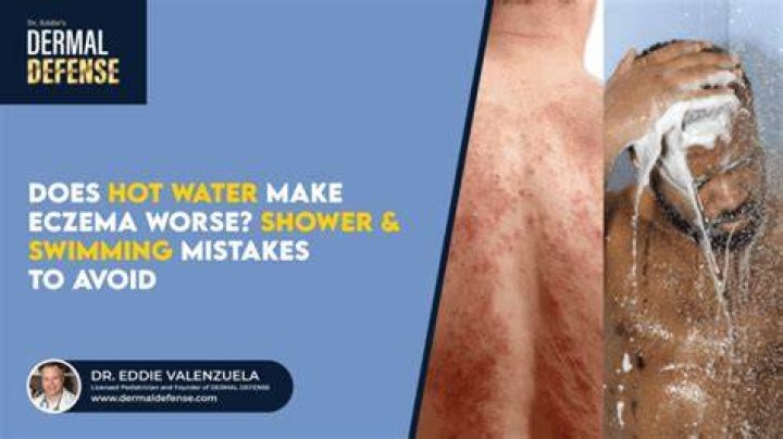 Why does water make eczema worse?