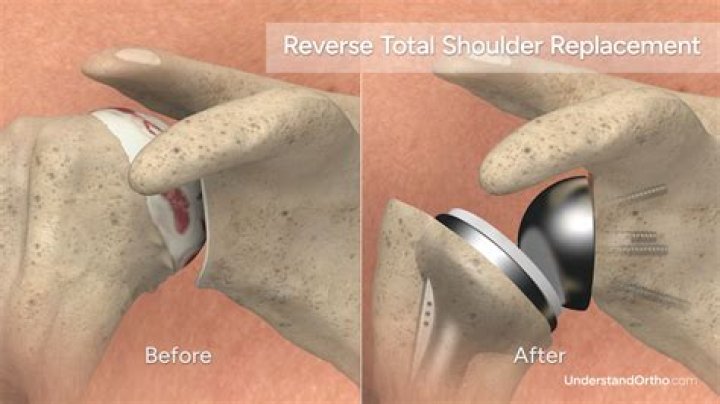 Why is a reverse shoulder replacement better?
