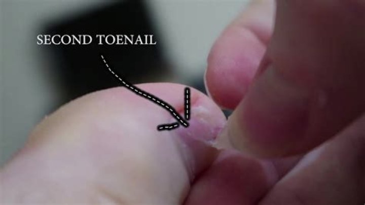 Why is there something growing under my toenail?